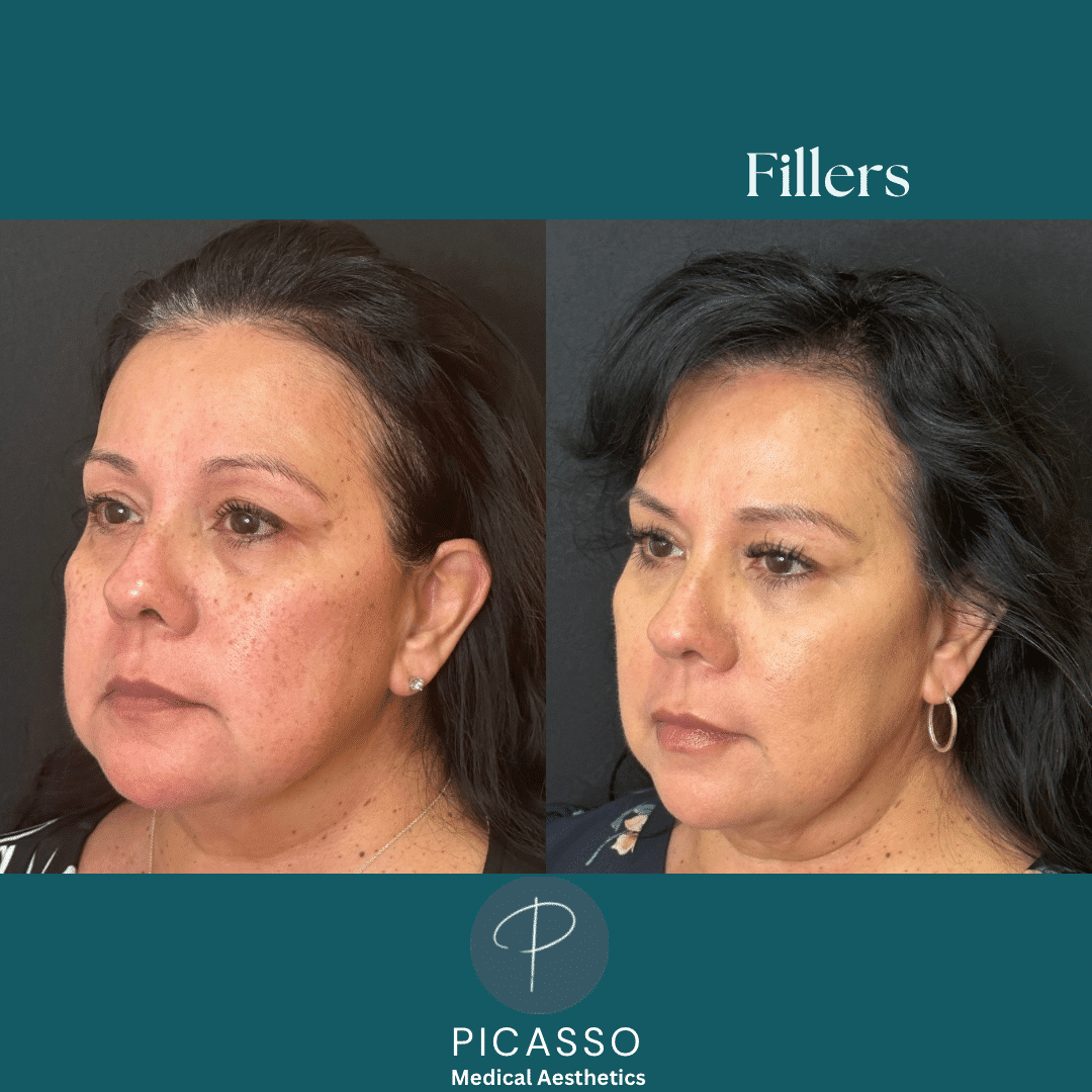 Before and After Image: Fillers - left-front-oblique