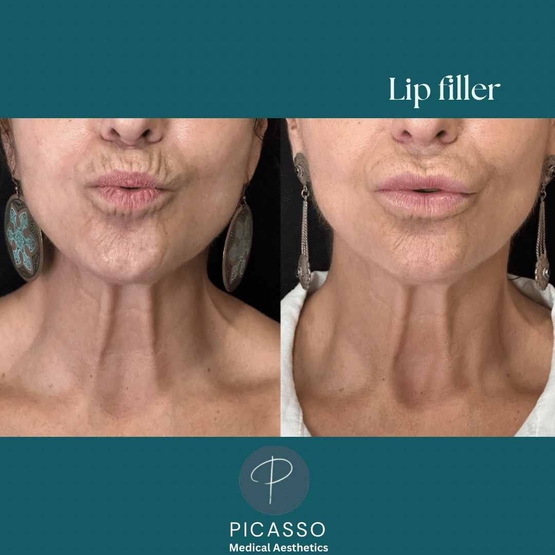 Before and After Image: Lip Filler - front