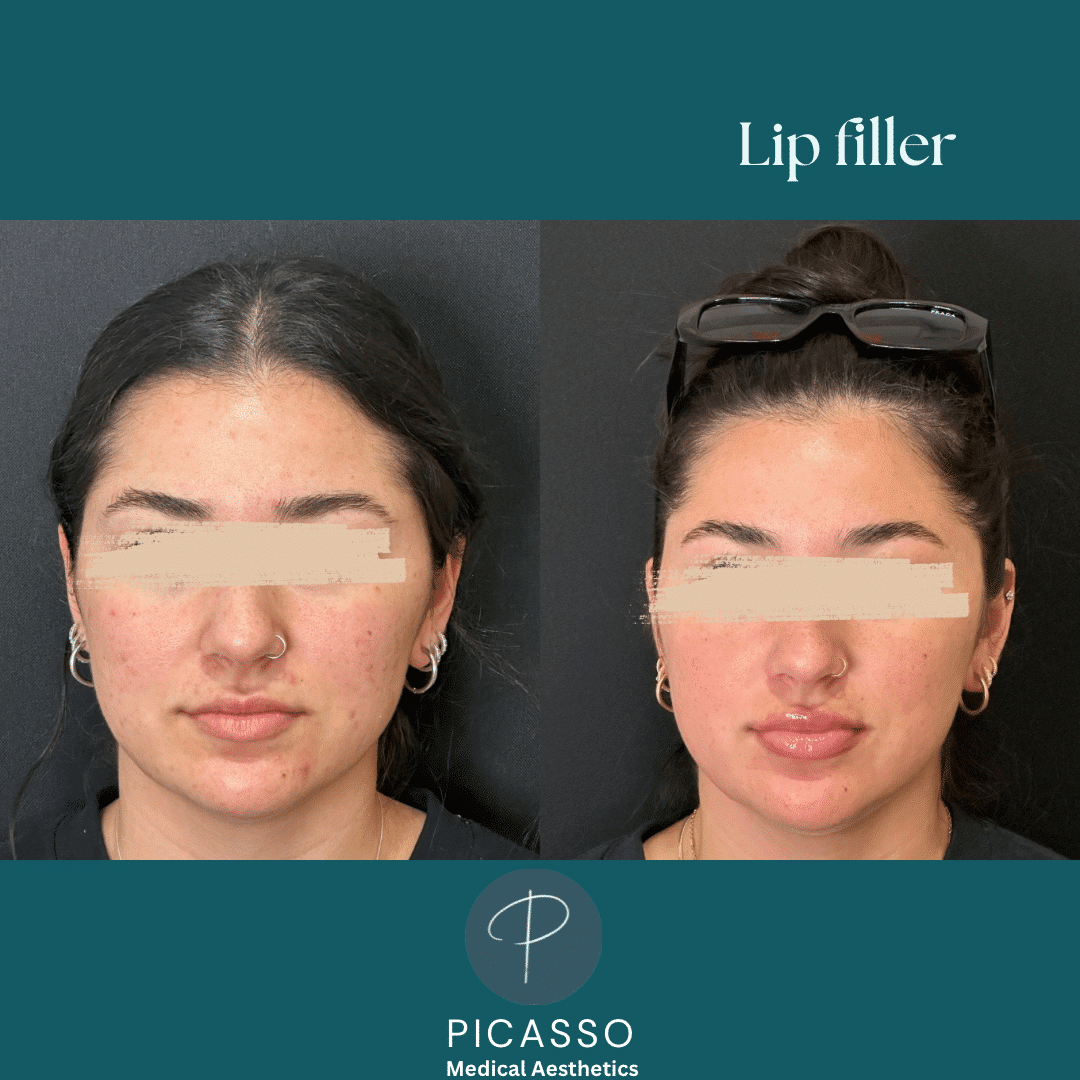 Before and After Image: Lip Filler - front