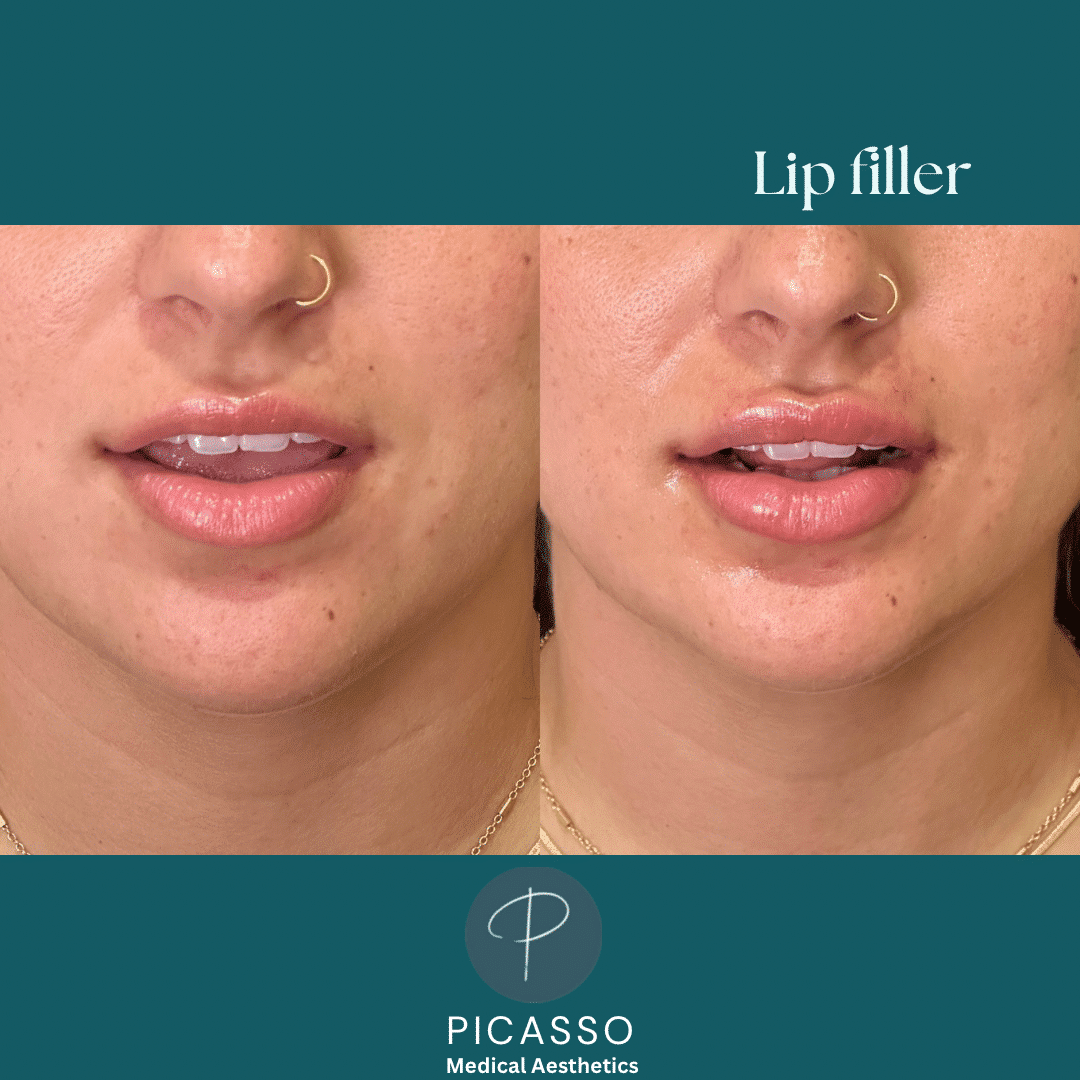 Before and After Image: Lip Filler - front