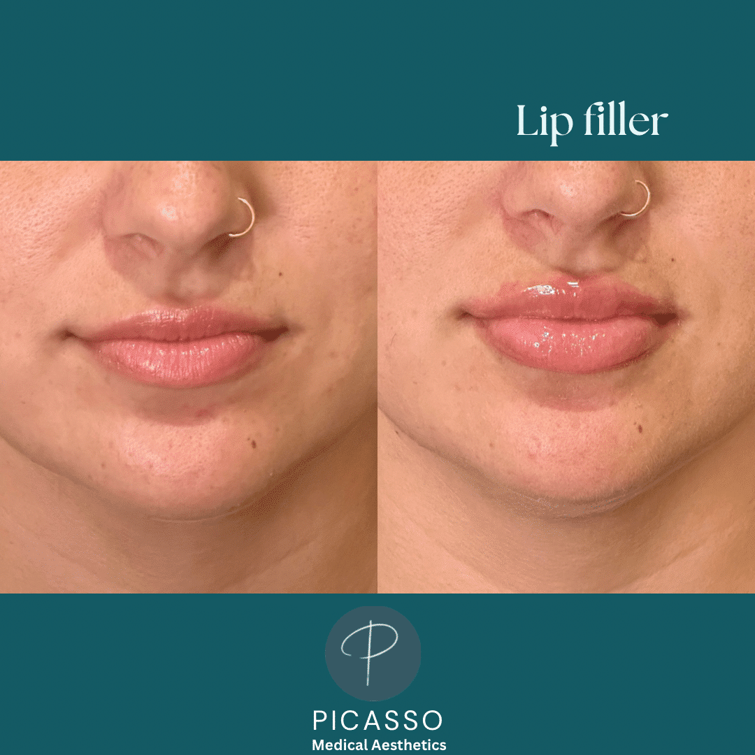 Before and After Image: Lip Filler - front