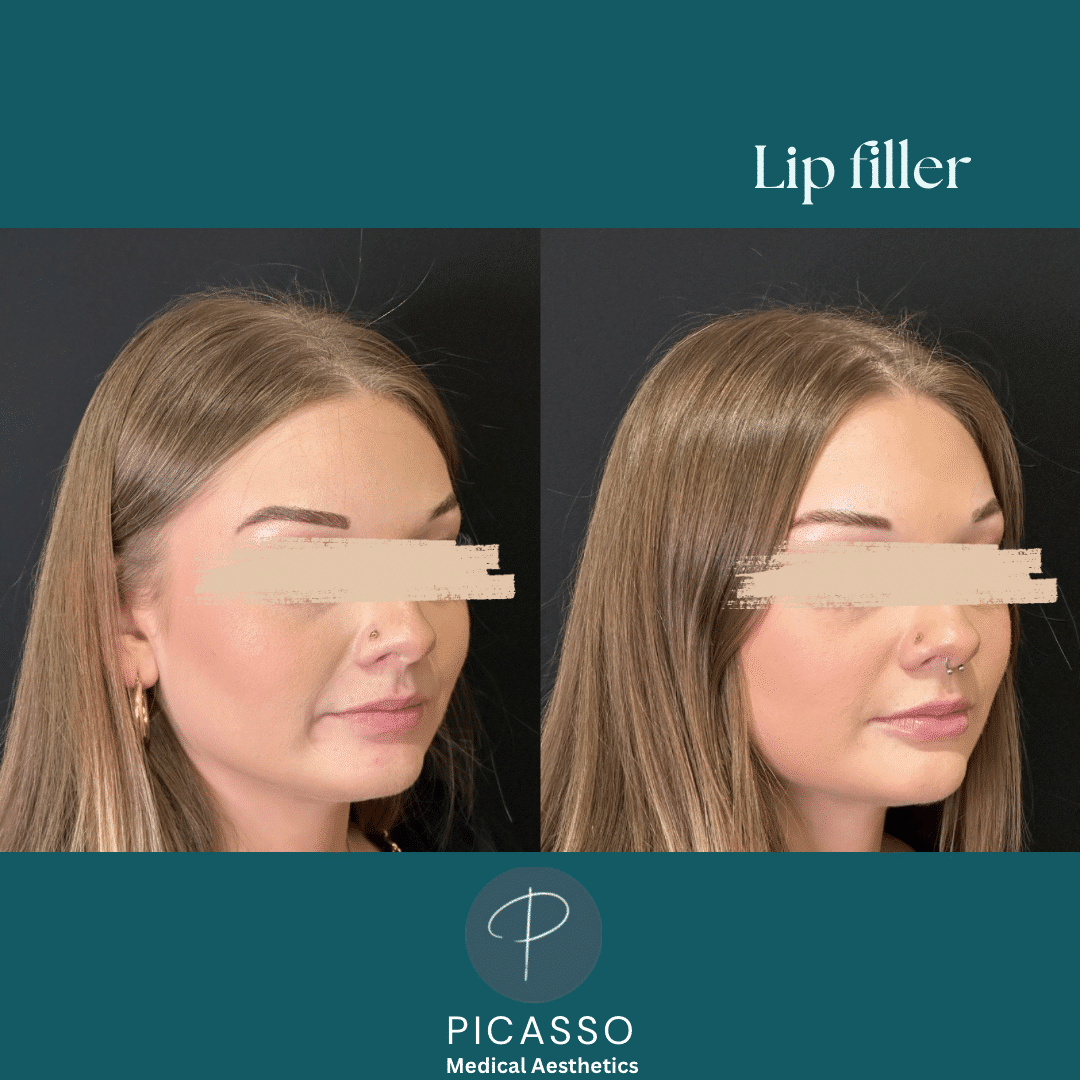 Before and After Image: Lip Filler - right-front-oblique