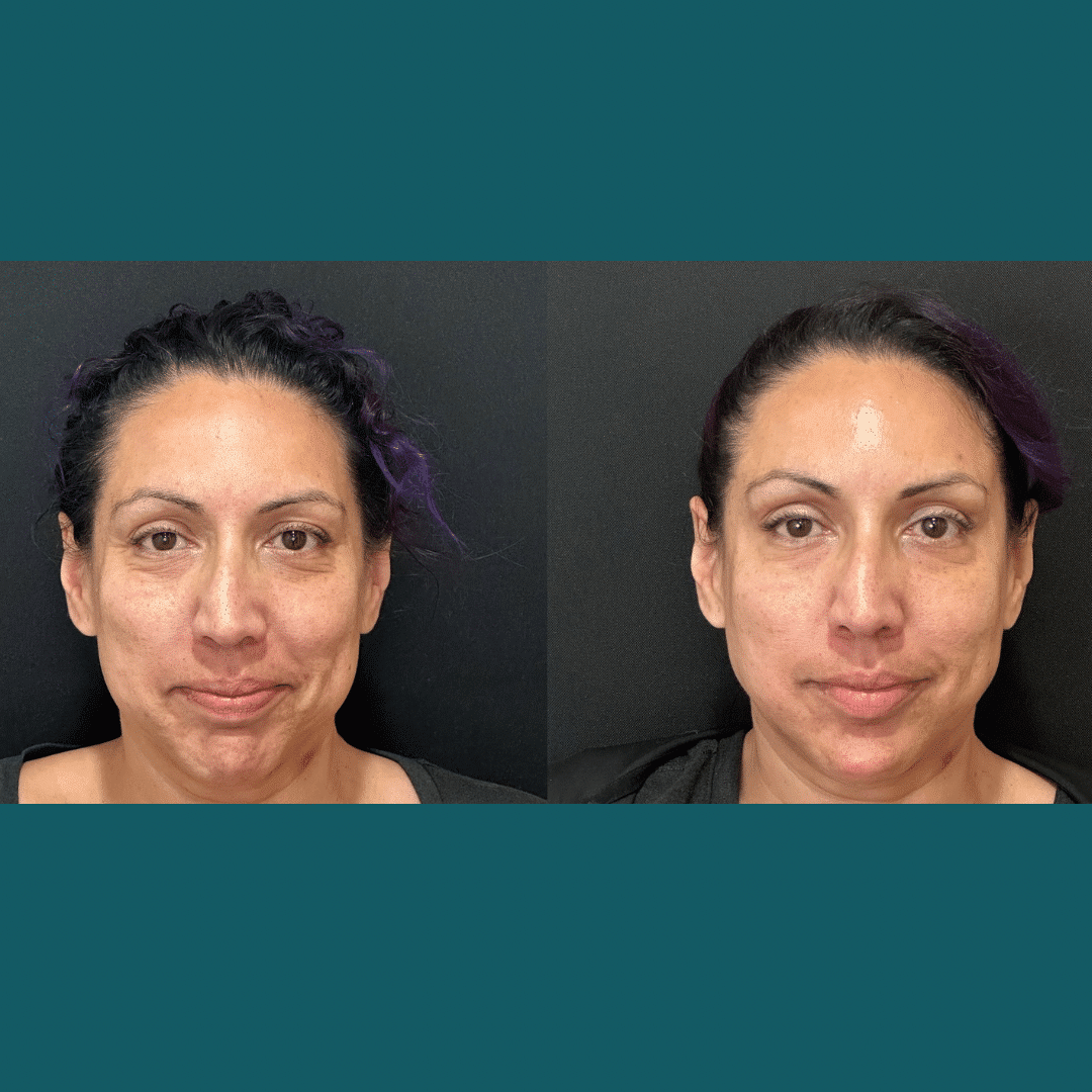 Before and After Image: Lip Filler - front