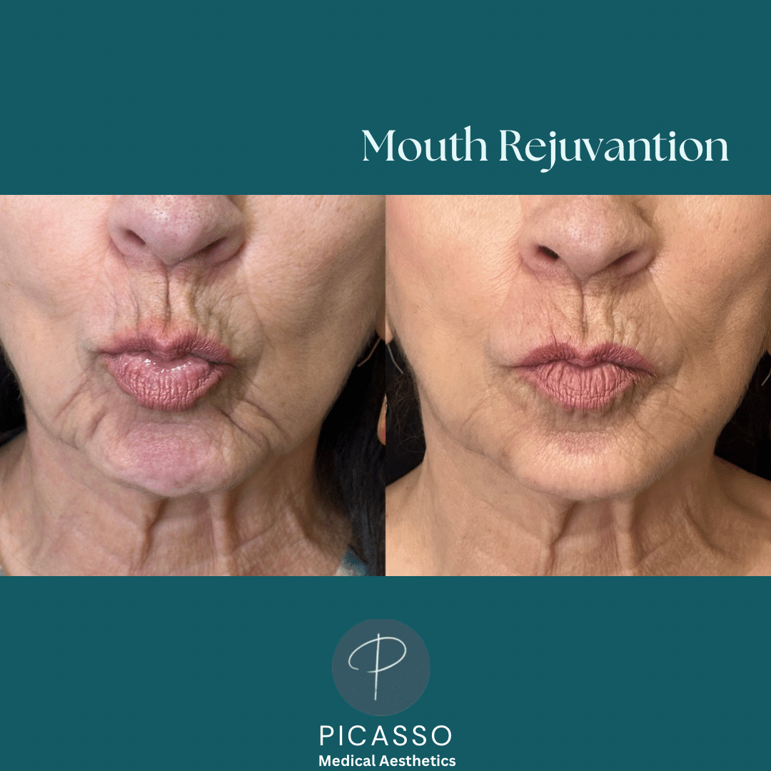 Before and After Image: Mouth Rejuvenation - front