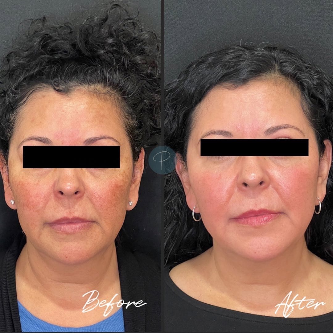 Before and After Image: Mouth Rejuvenation - front