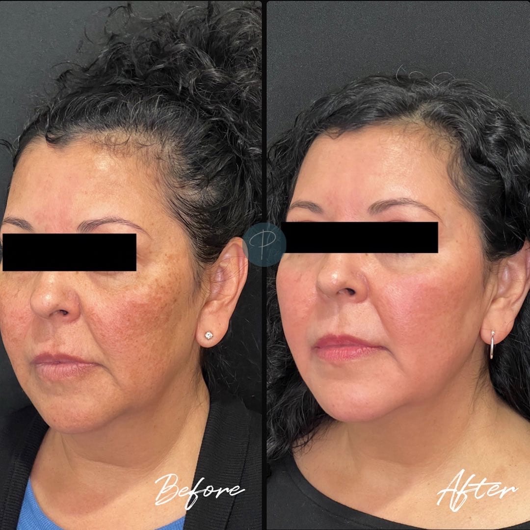 Before and After Image: Mouth Rejuvenation - left-front-oblique