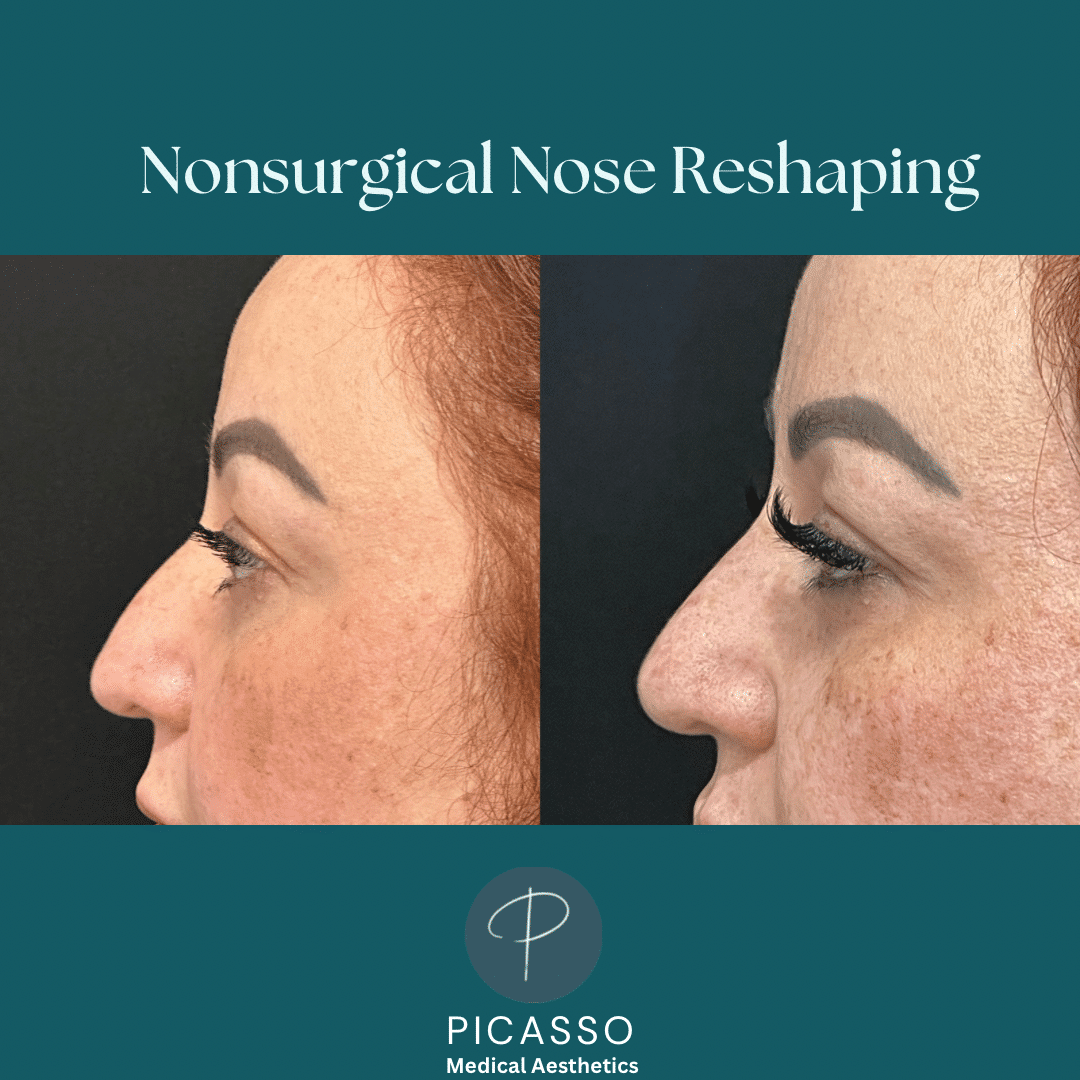 Before and After Image: Nonsurgical Nose Reshaping - left-side