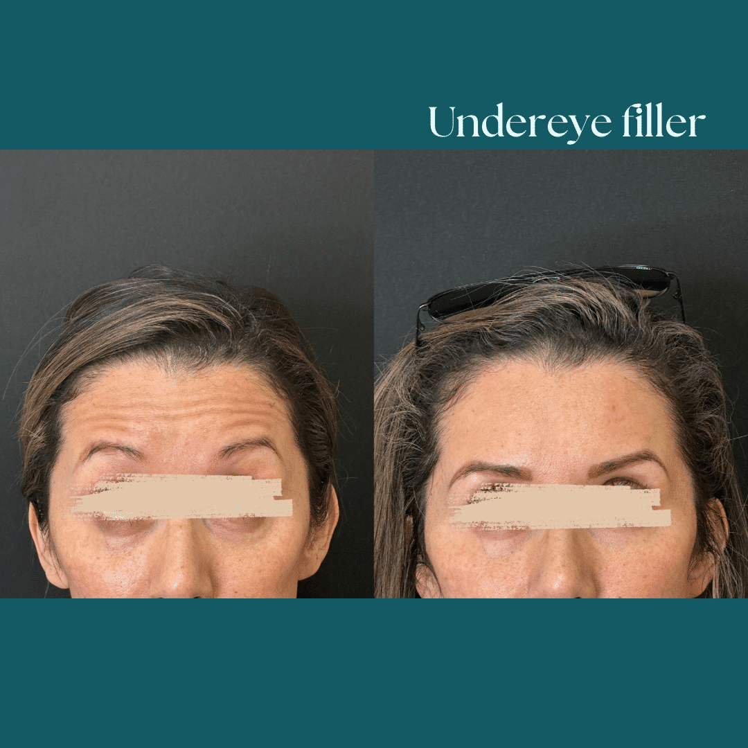 Before and After Image: Undereye Filler - front