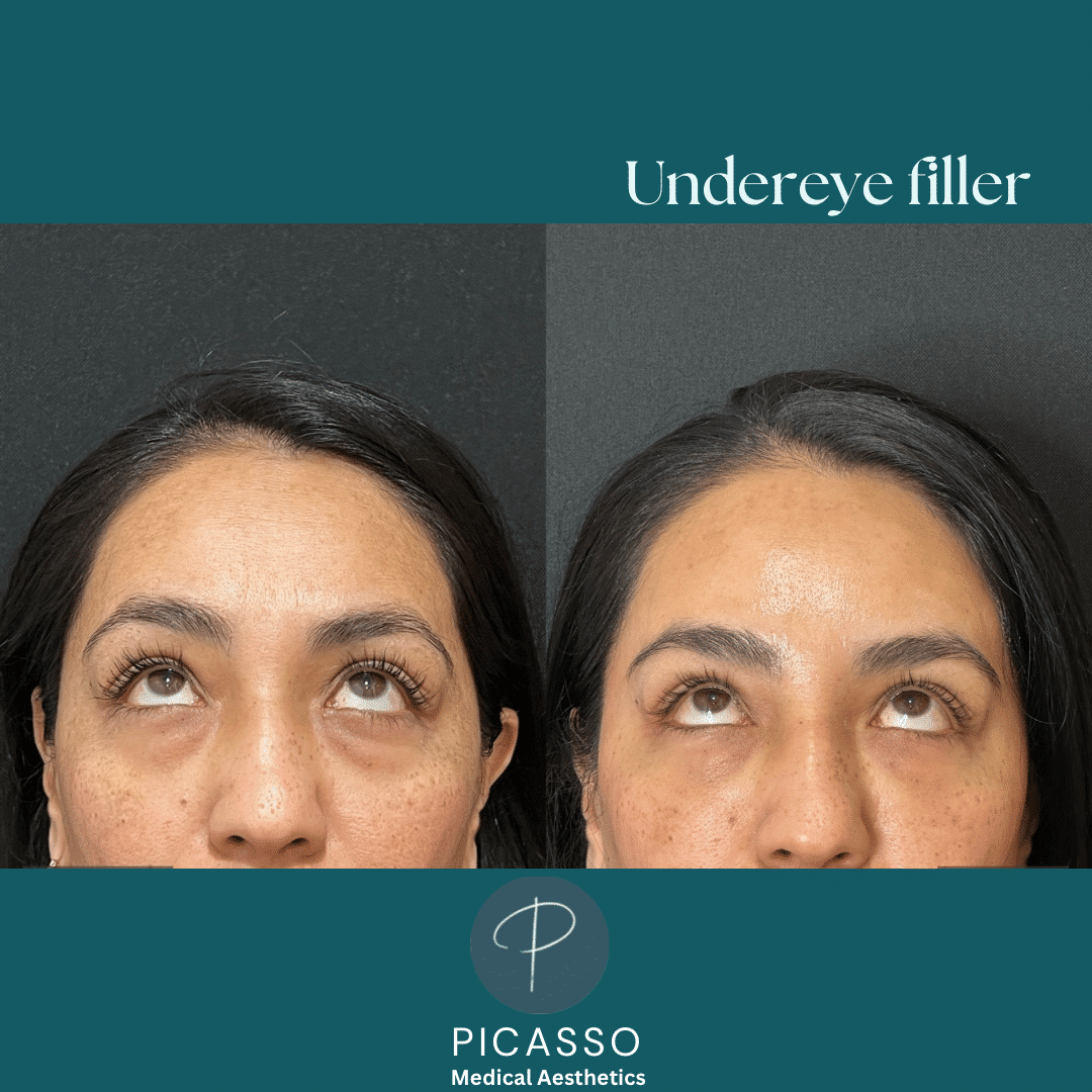 Before and After Image: Undereye Filler - right-front-oblique