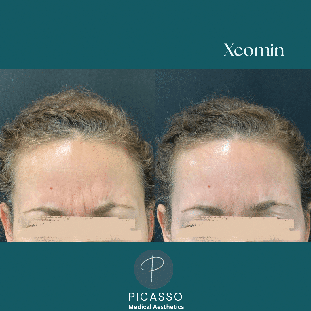 Before and After Image: Xeomin - front