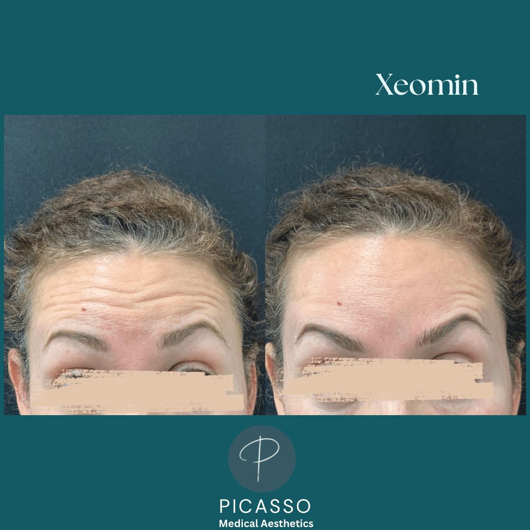Before and After Image: Xeomin - front