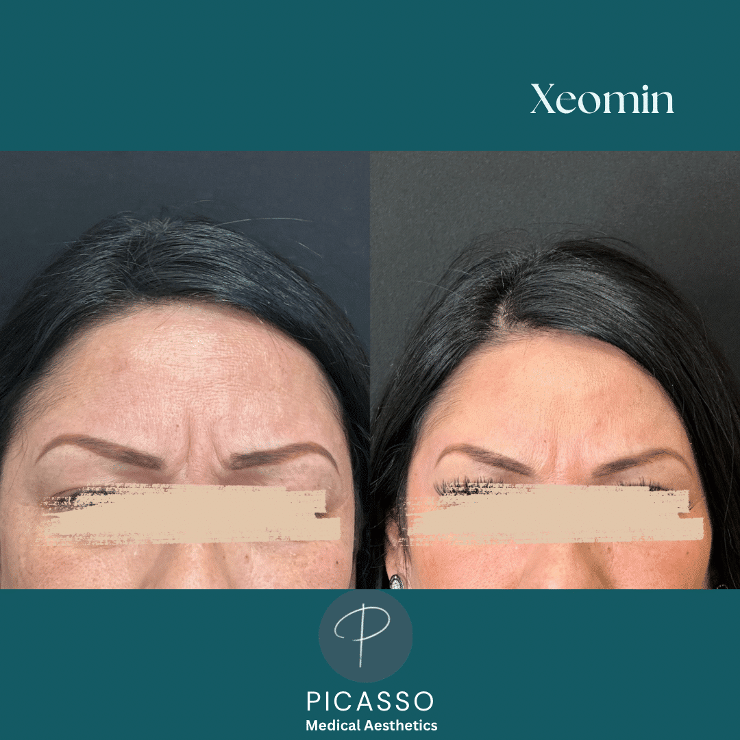 Before and After Image: Xeomin - front