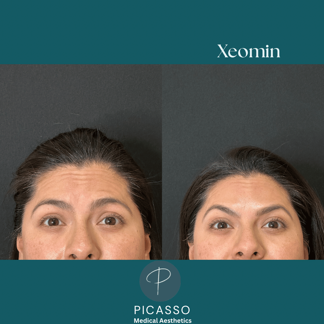 Before and After Image: Xeomin - front