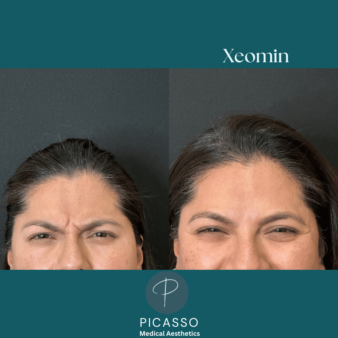 Before and After Image: Xeomin - front