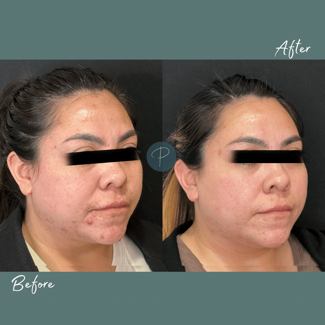 Before and After Image: Acne Treatments (Microderm with Obagi Clenziderm) - 