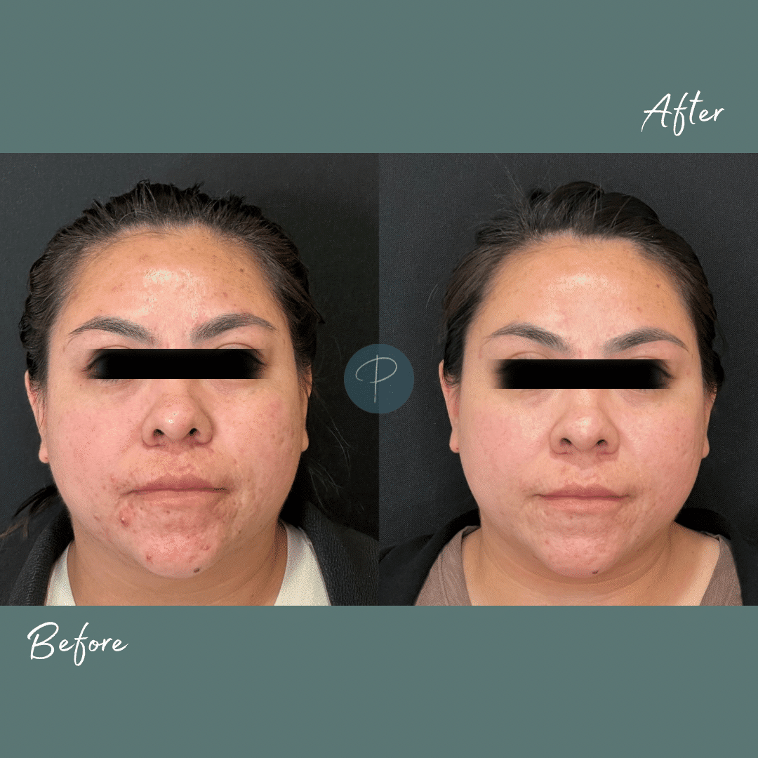 Before and After Image: Acne Treatments (Microderm with Obagi Clenziderm) - front
