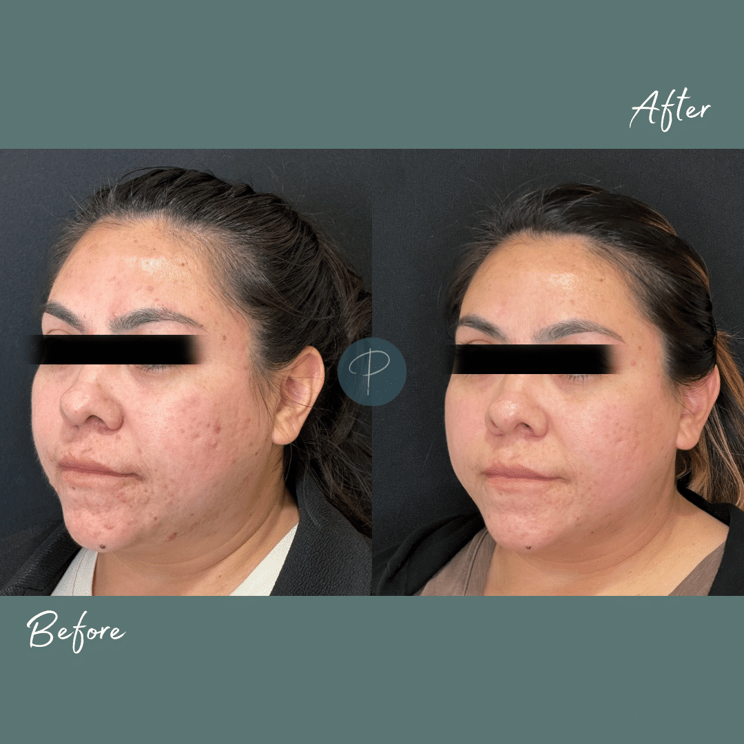 Before and After Image: Acne Treatments (Microderm with Obagi Clenziderm) - left-front-oblique