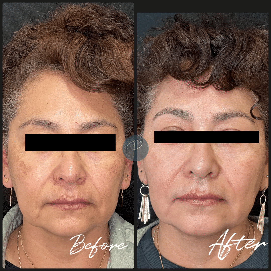 Before and After Image: Cosmelan Peel - front