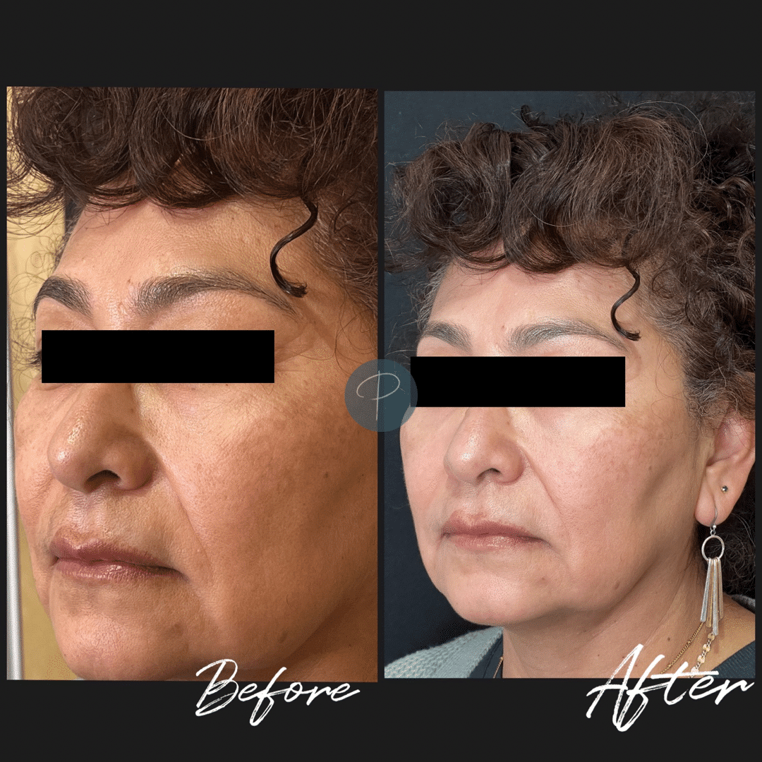 Before and After Image: Cosmelan Peel - left-front-oblique