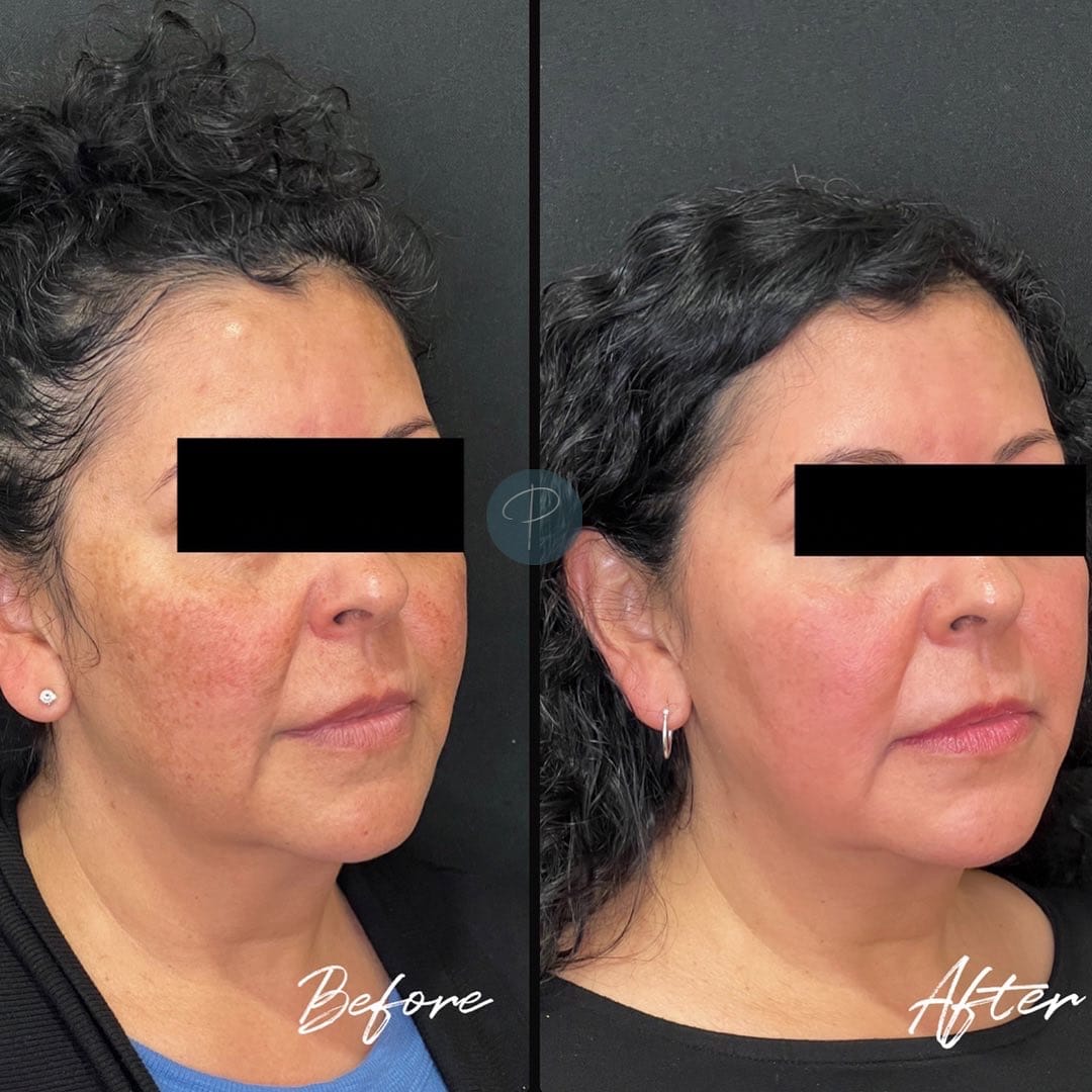 Before and After Image: Cosmelan Peel - right-front-oblique