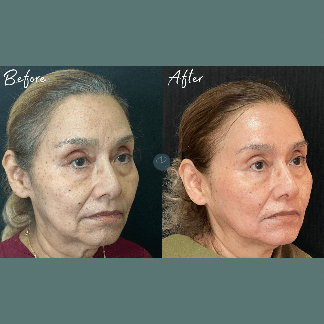 Before and After Image: Cosmelan Peel - front