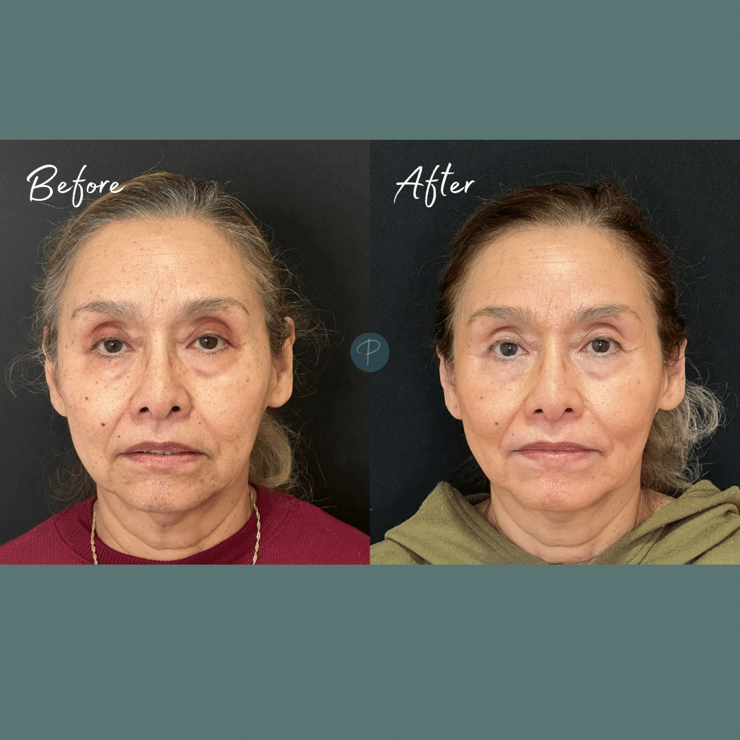 Before and After Image: Cosmelan Peel - front