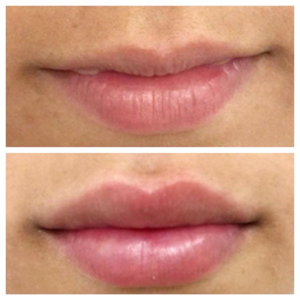 Before and After Image: Lip Filler - front