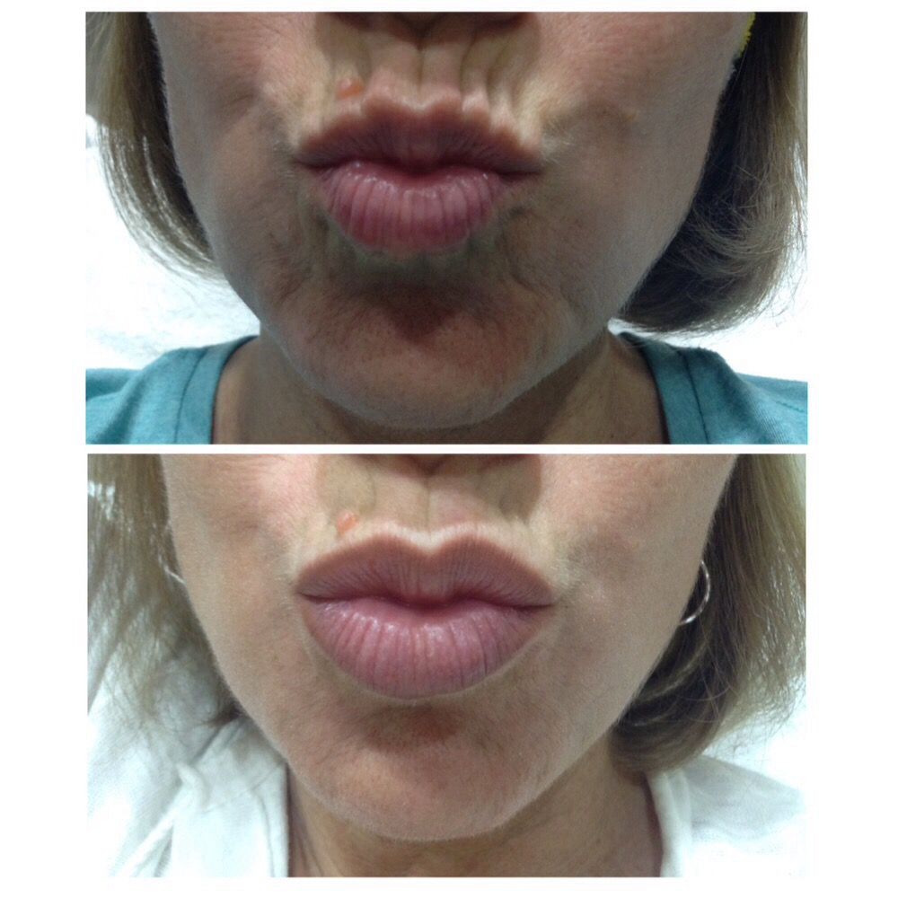 Before and After Image: Lip + Mouth Rejuvenation - front