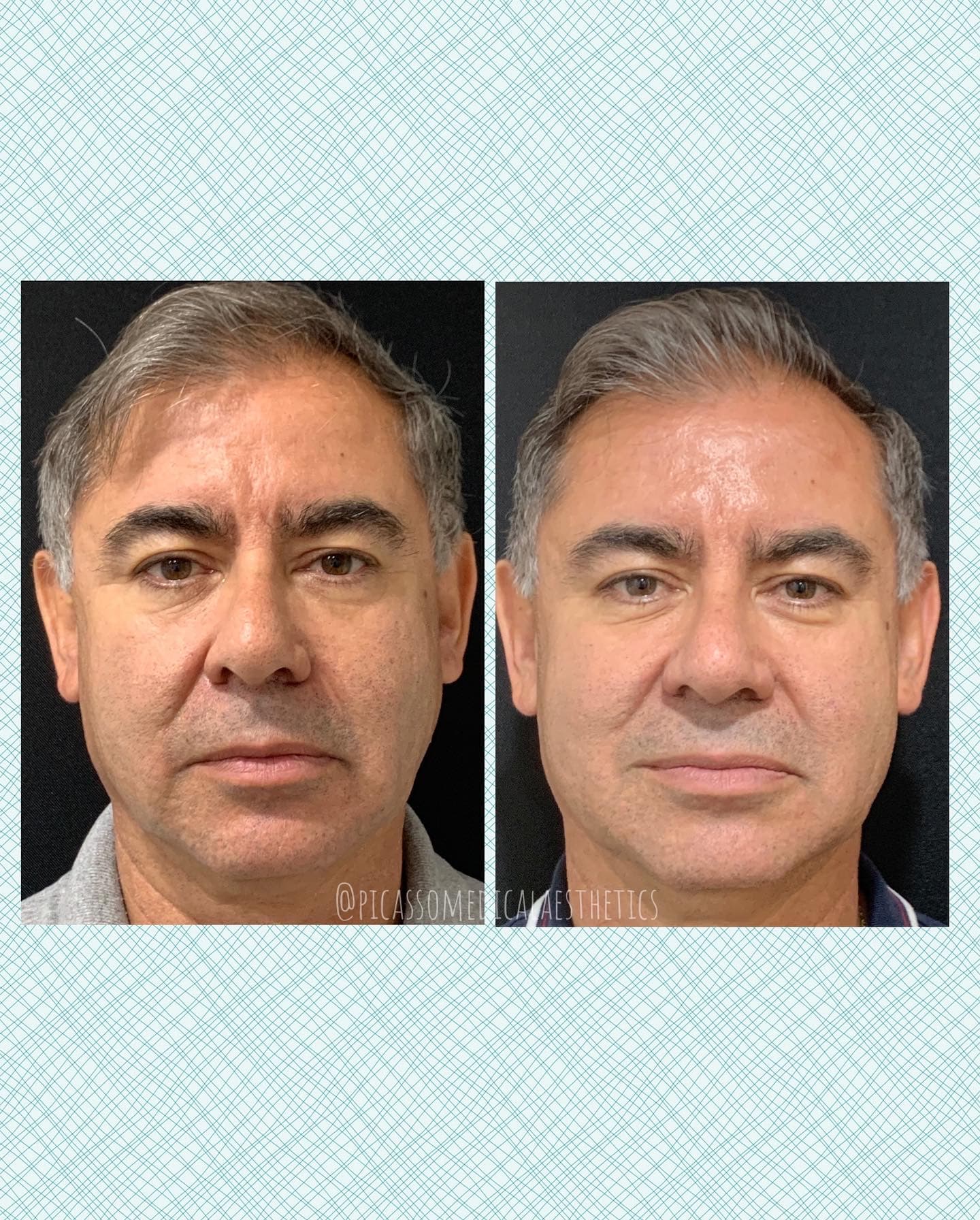 Before and After Image: Sculptra - front