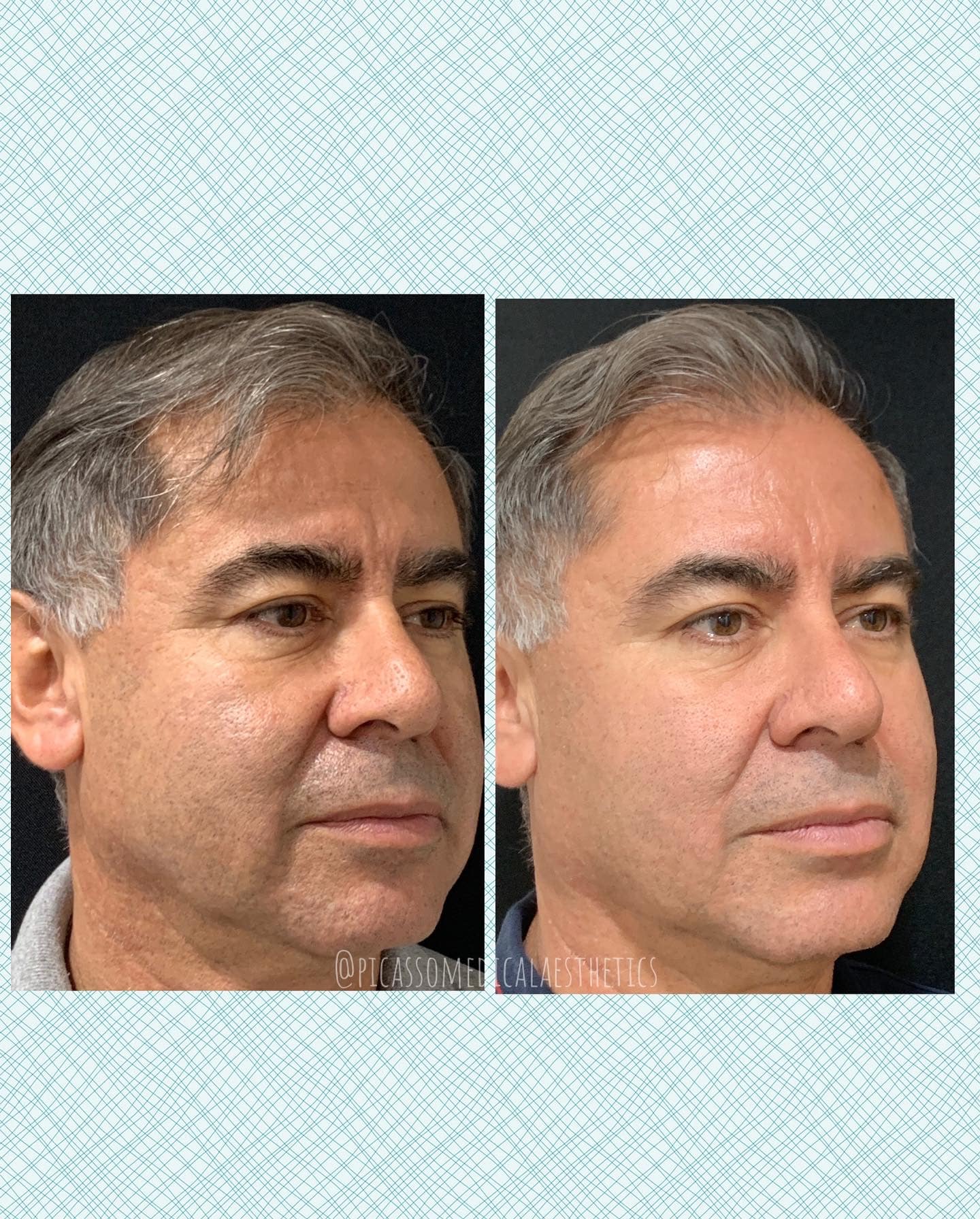 Before and After Image: Sculptra - right-front-oblique