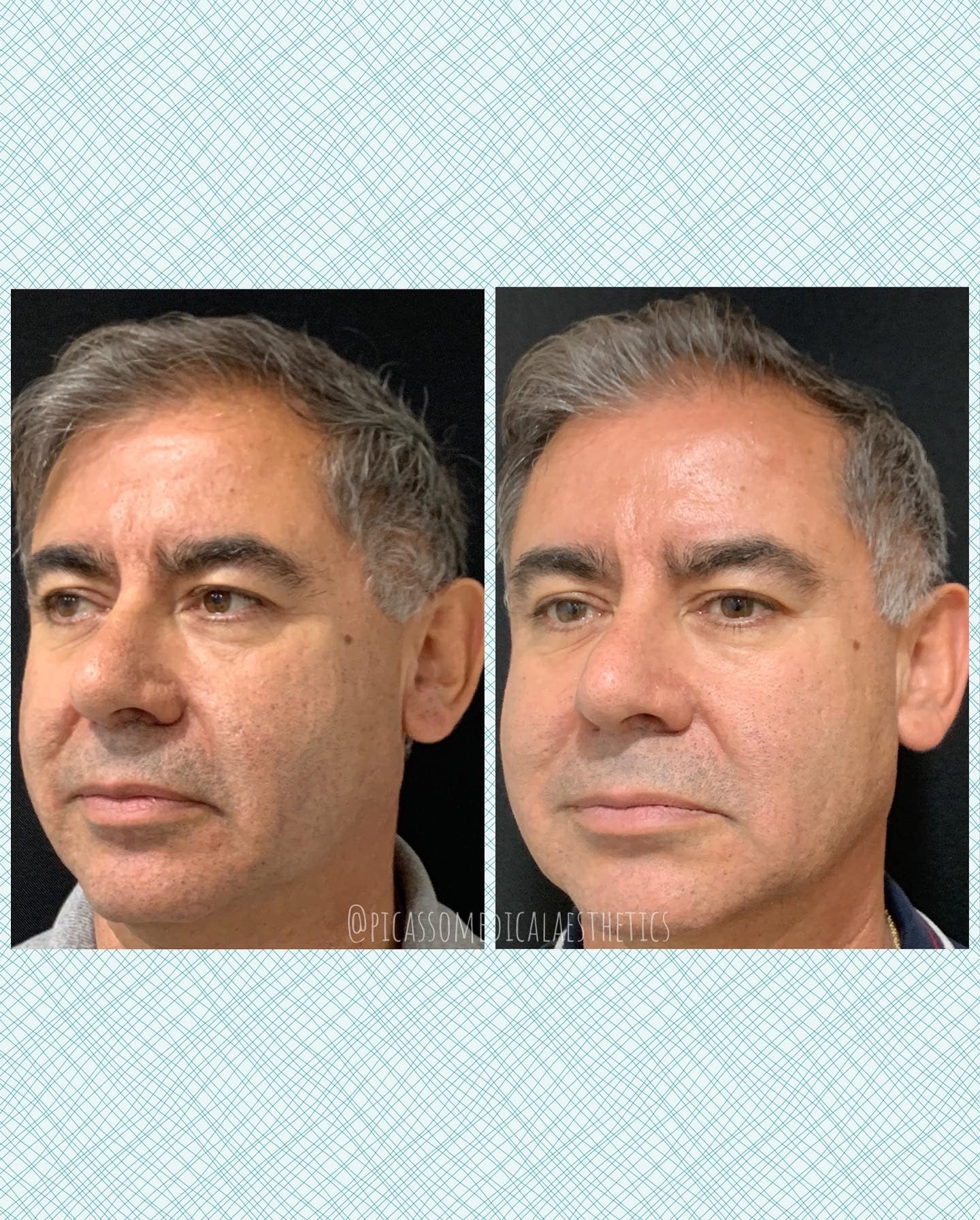 Before and After Image: Sculptra - left-front-oblique