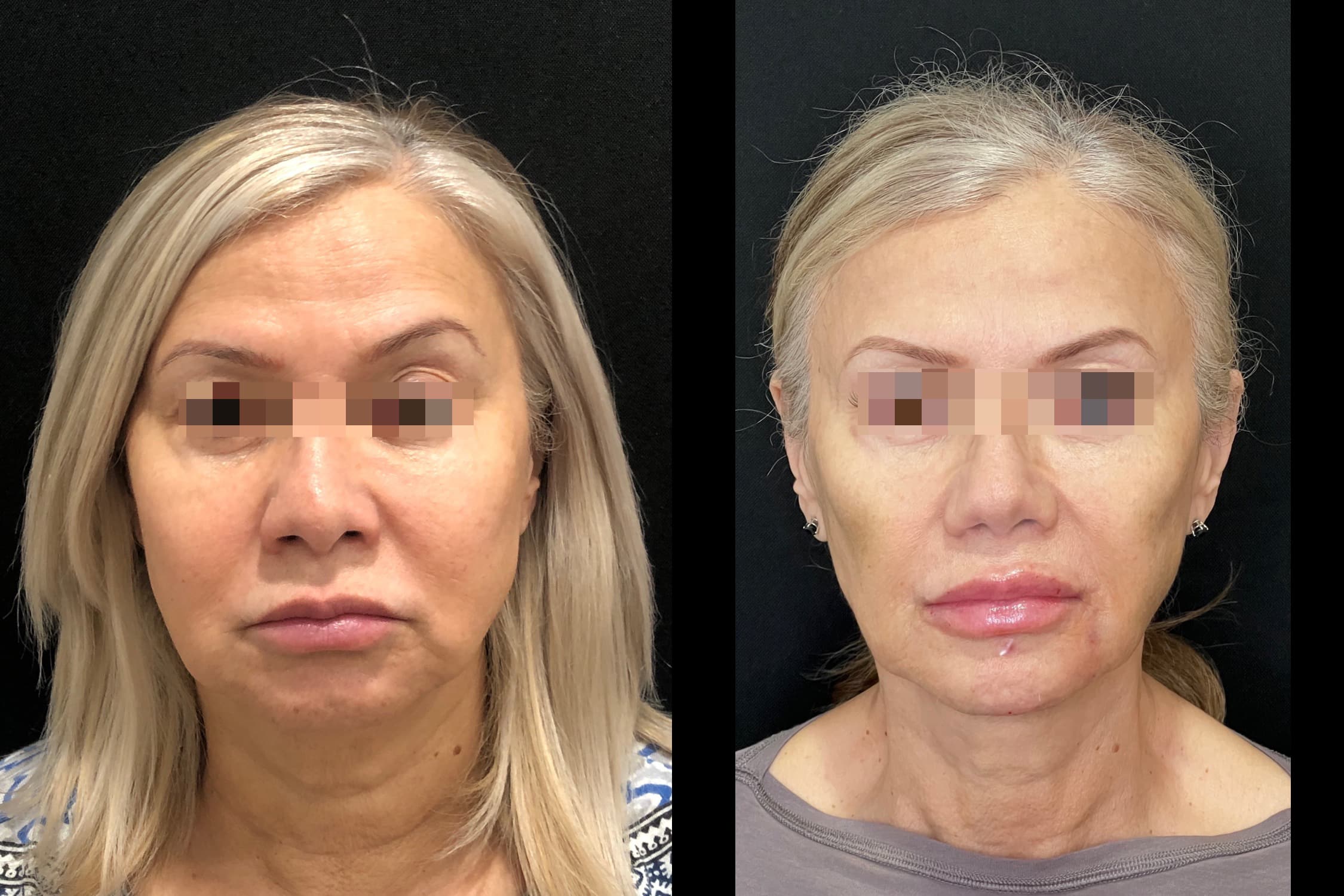 Before and After Image: Sculptra+Lip Filler+Weight Loss - front