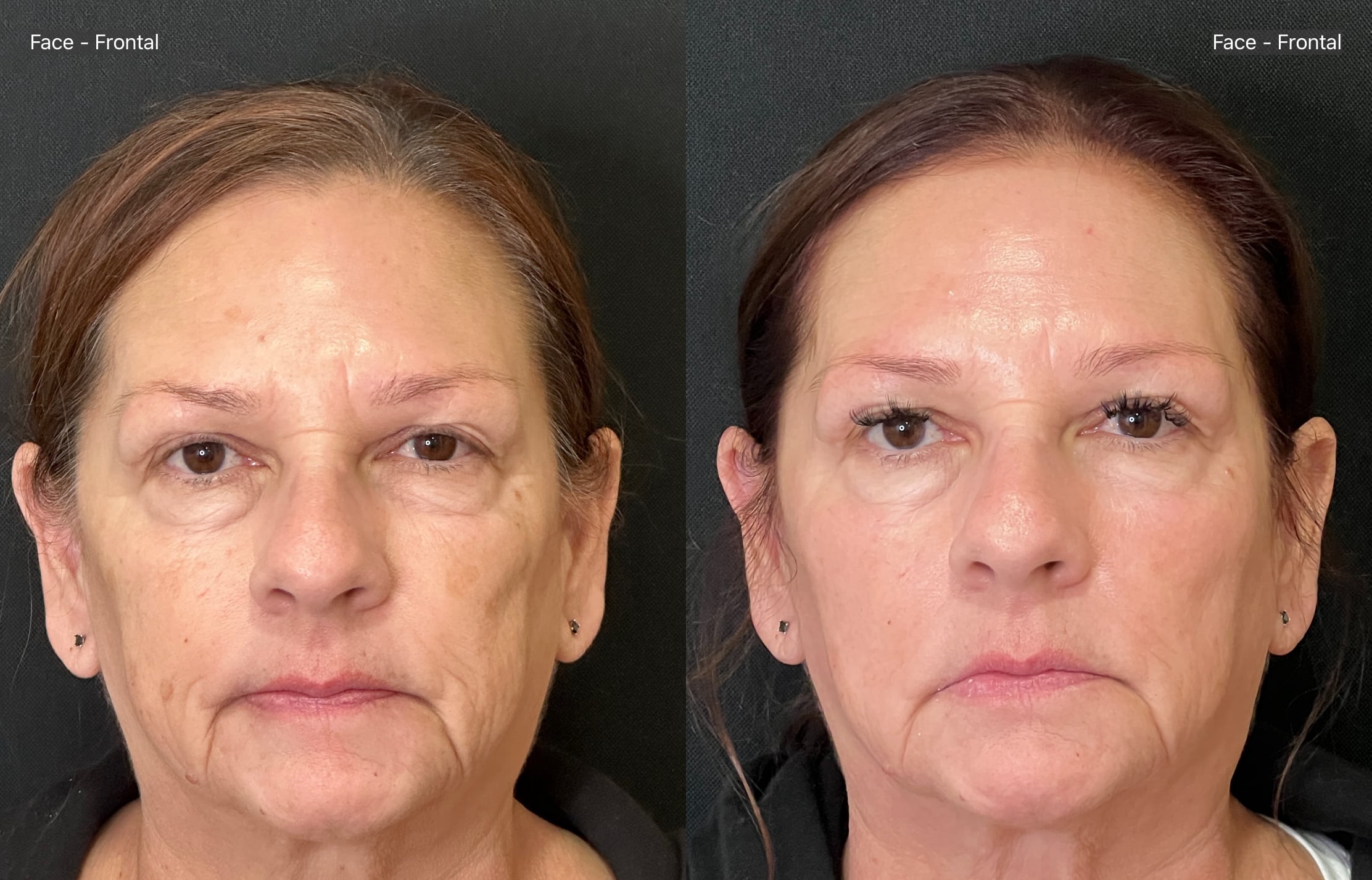 Before and After Image: TriLift with Obagi Nuderm System - front
