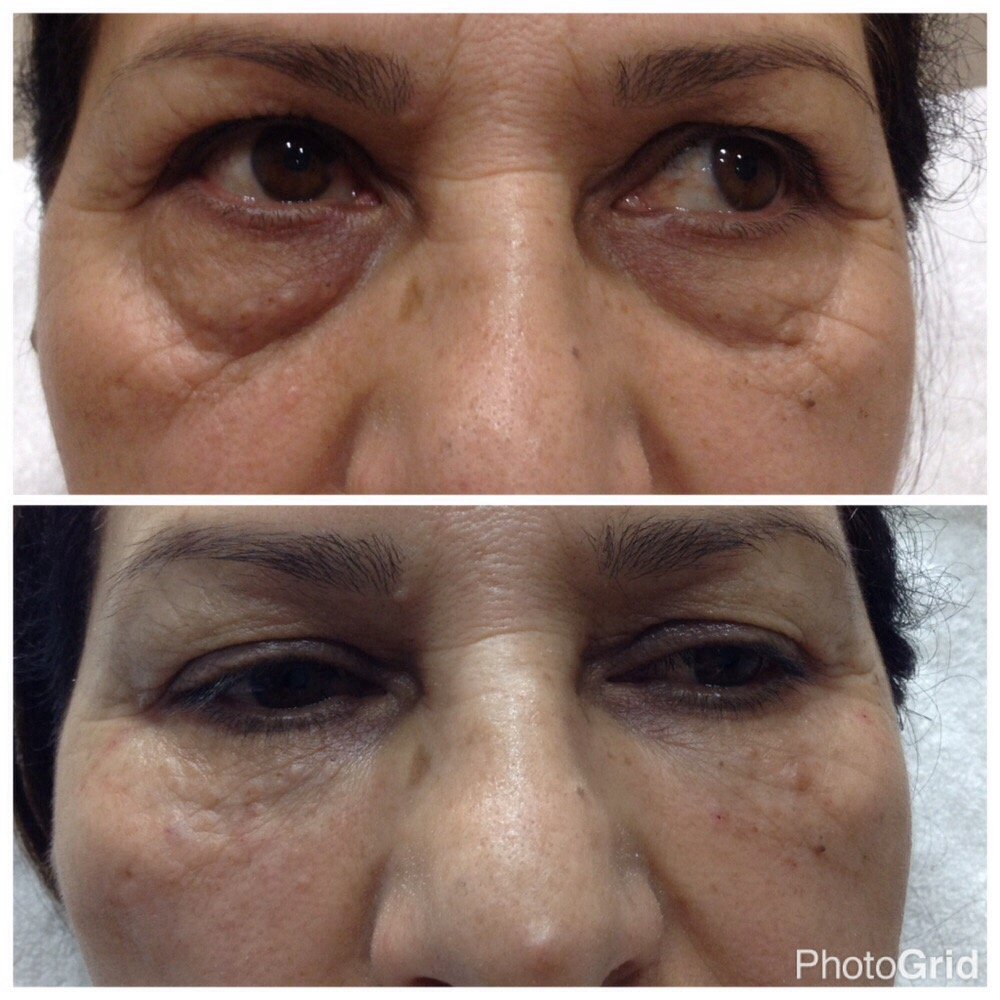 Before and After Image: Under Eye Rejuvenation - front