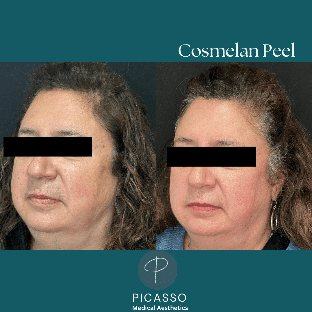 Before and After Image: Cosmelan Peel - left-front-oblique