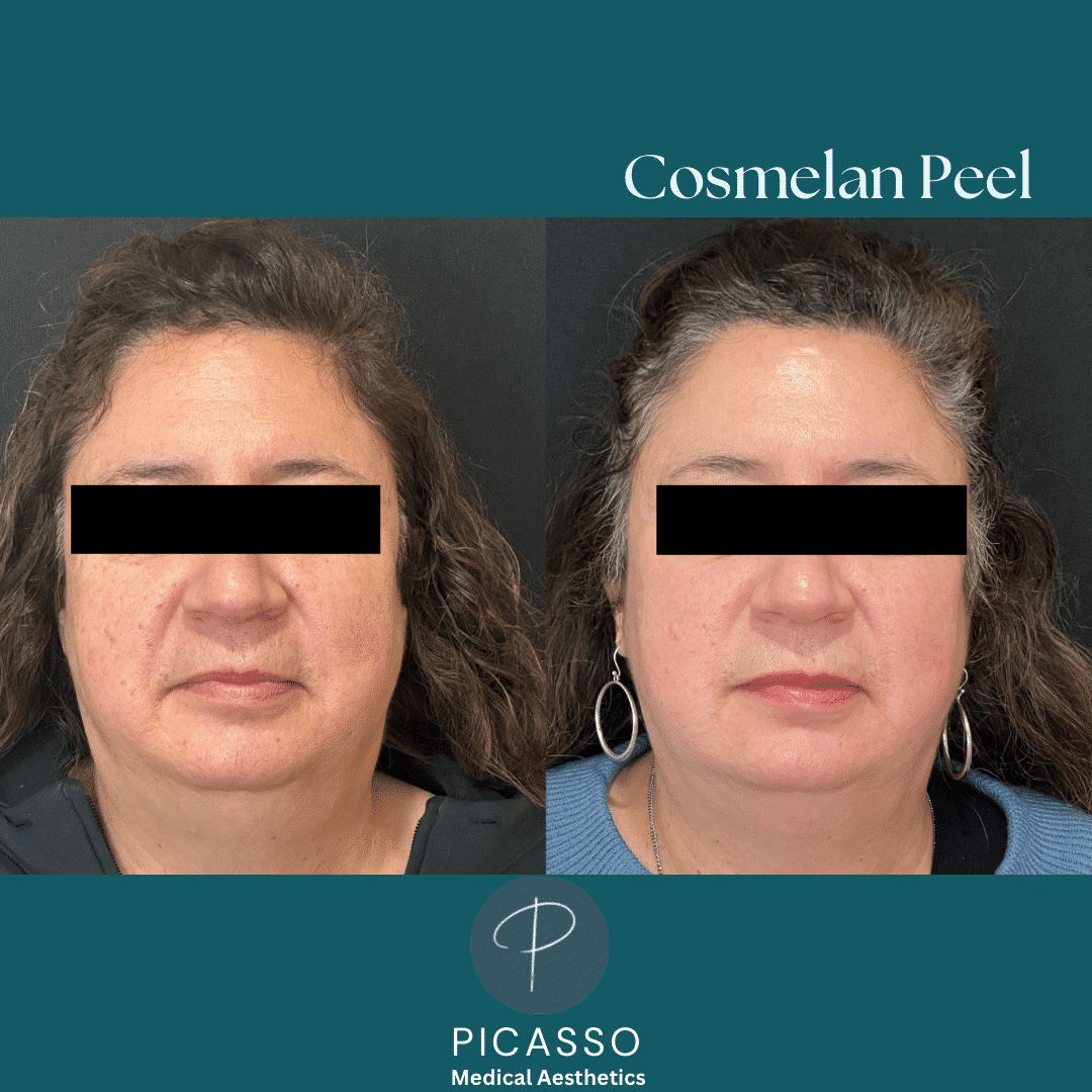Before and After Image: Cosmelan Peel - front