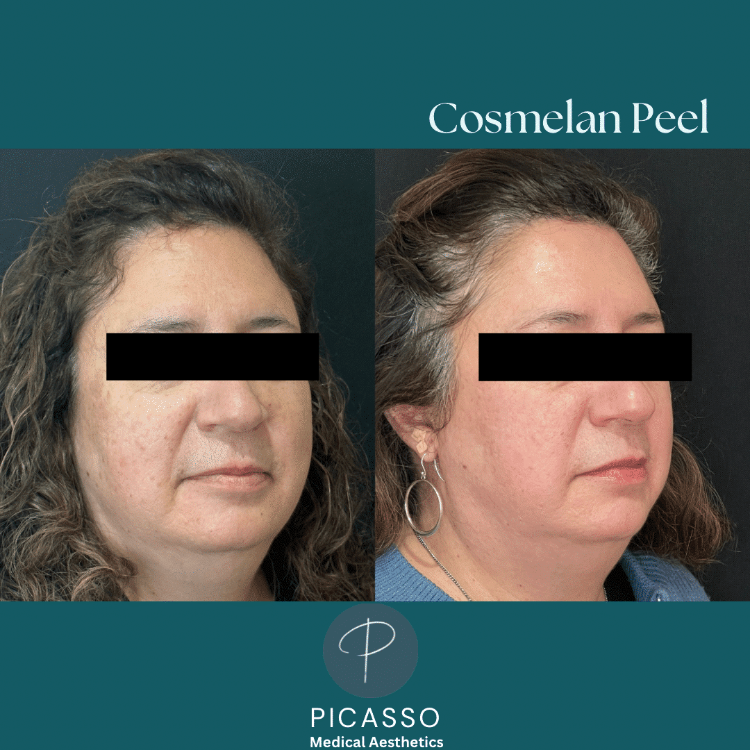 Before and After Image: Cosmelan Peel - right-front-oblique