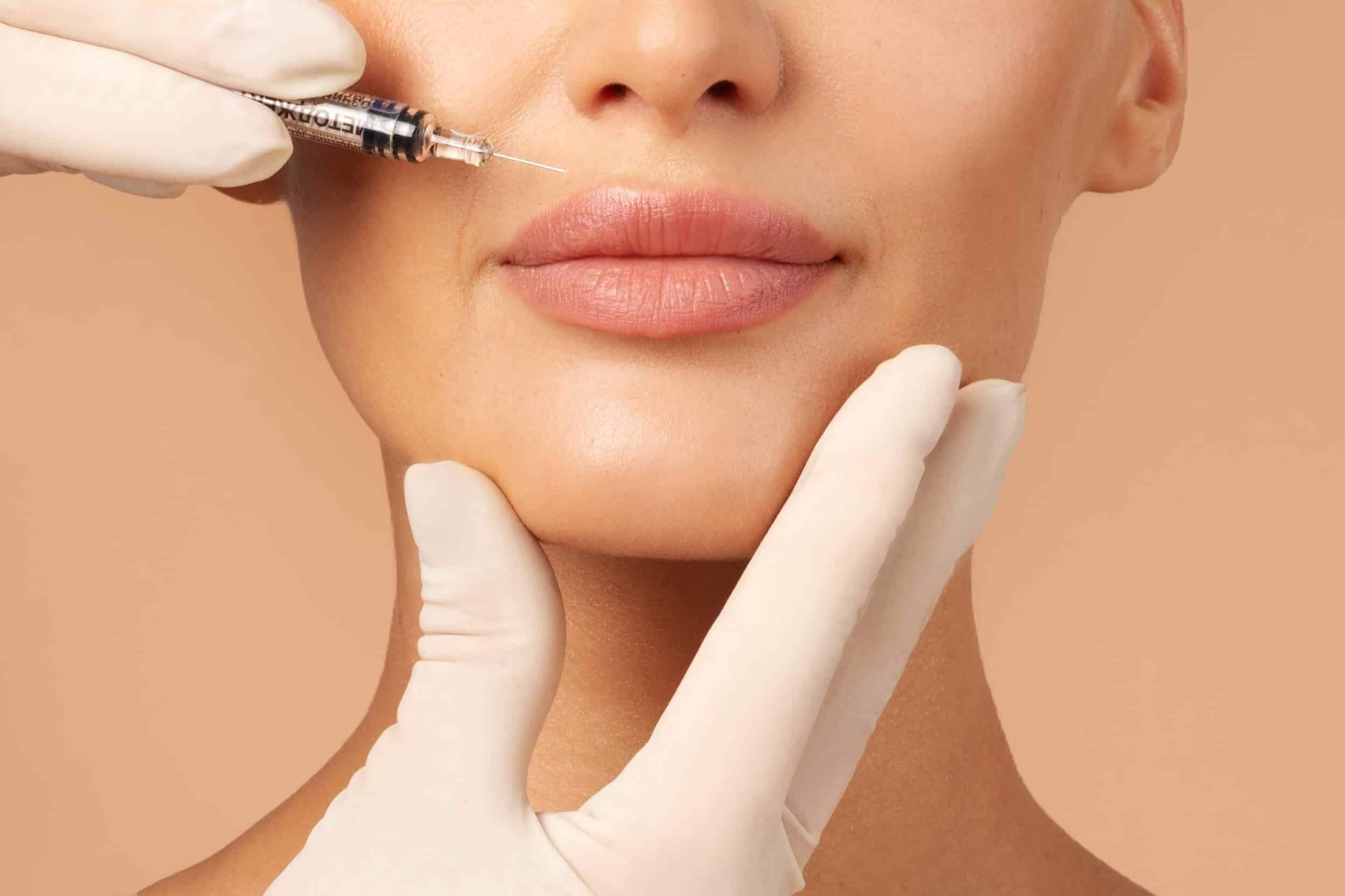 Close up of woman's lips getting injectable filler in Whittier, CA