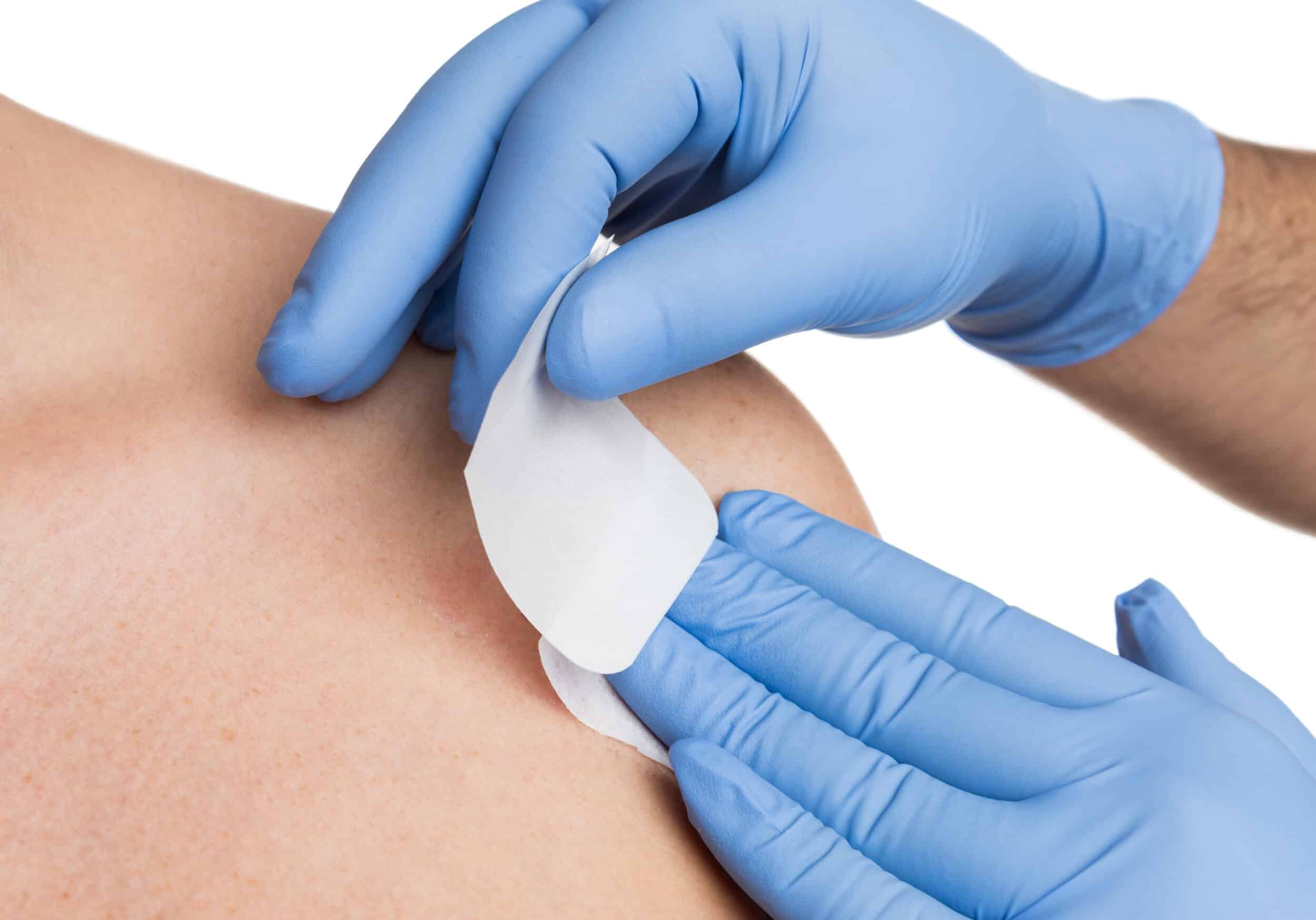 Nurse putting bandage on skin after mole removal in Whittier, CA