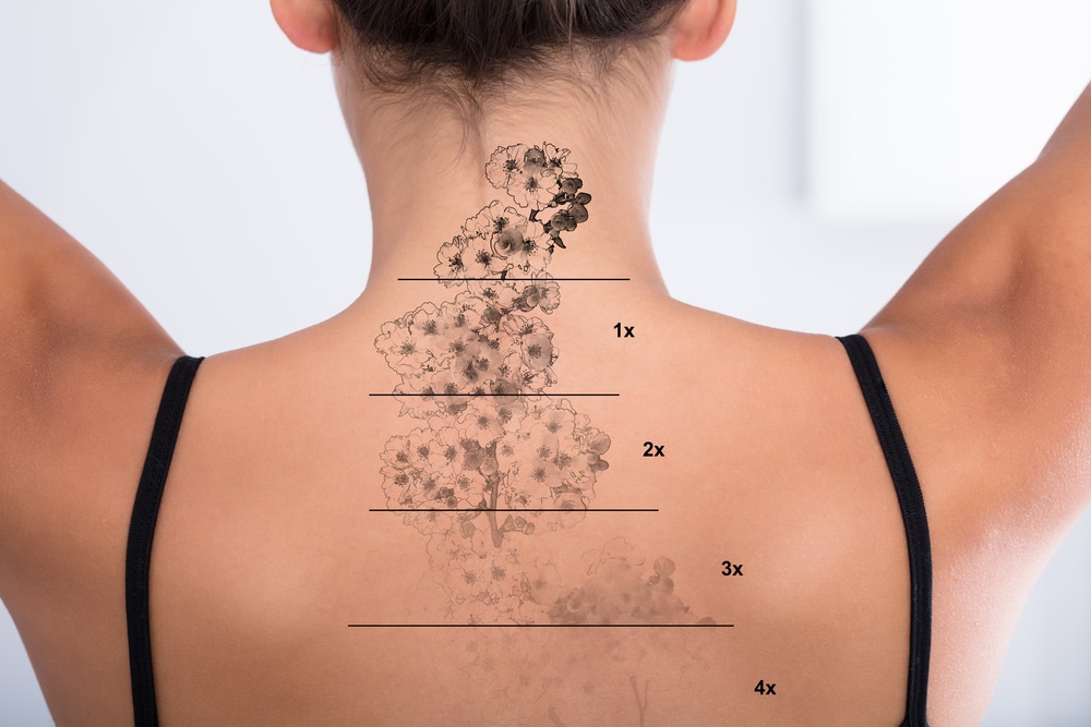 Woman's back with a tattoo showing various stages of removal